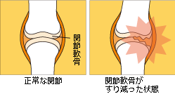 あなたの関節は大丈夫？